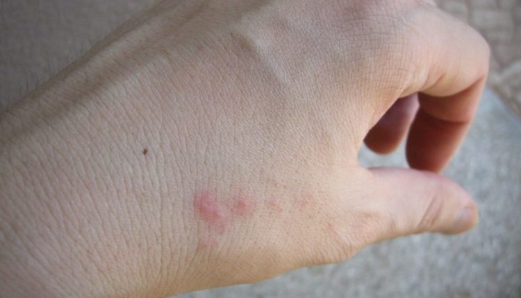 Bedbug bites